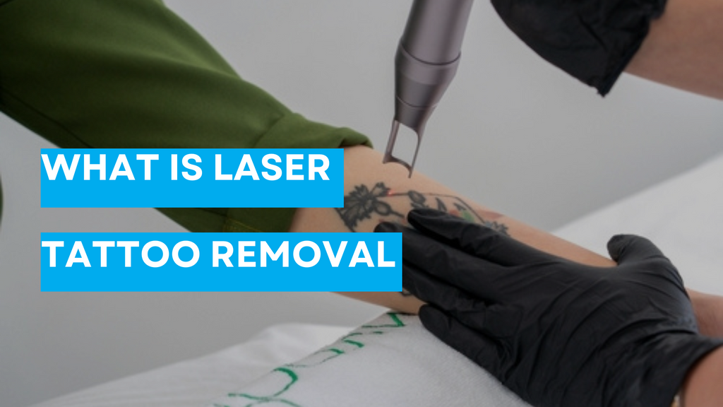What is laser tattoo removal